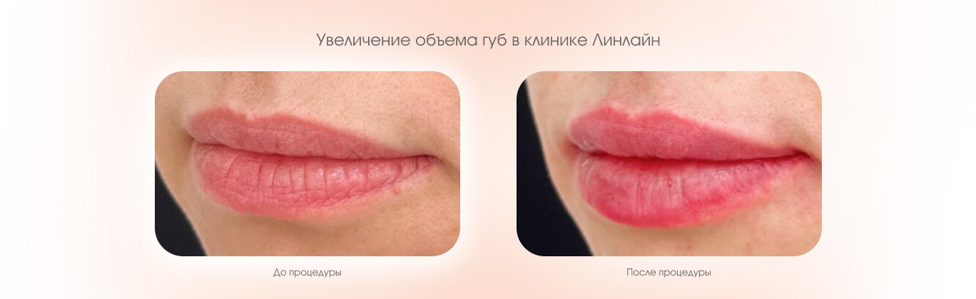 Увеличение объема губ