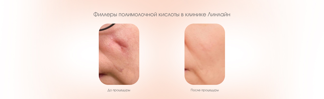 До и после процедуры