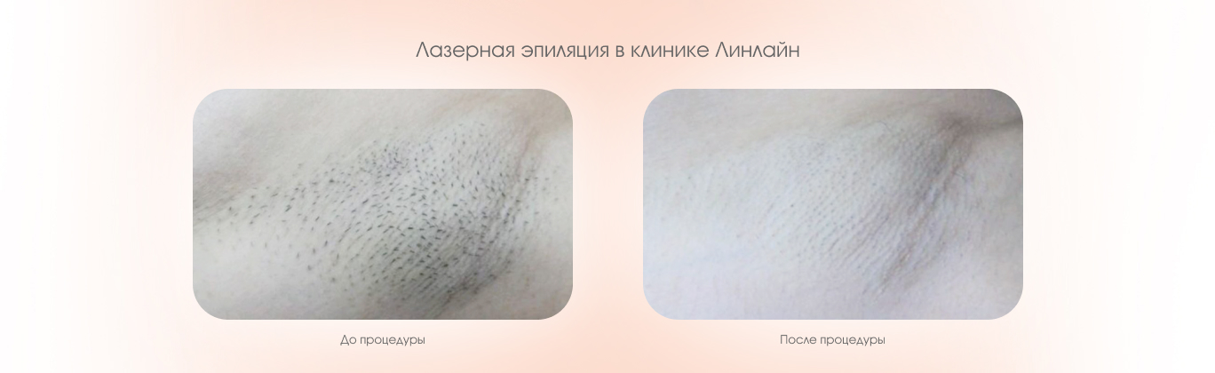 Лазерная эпиляция