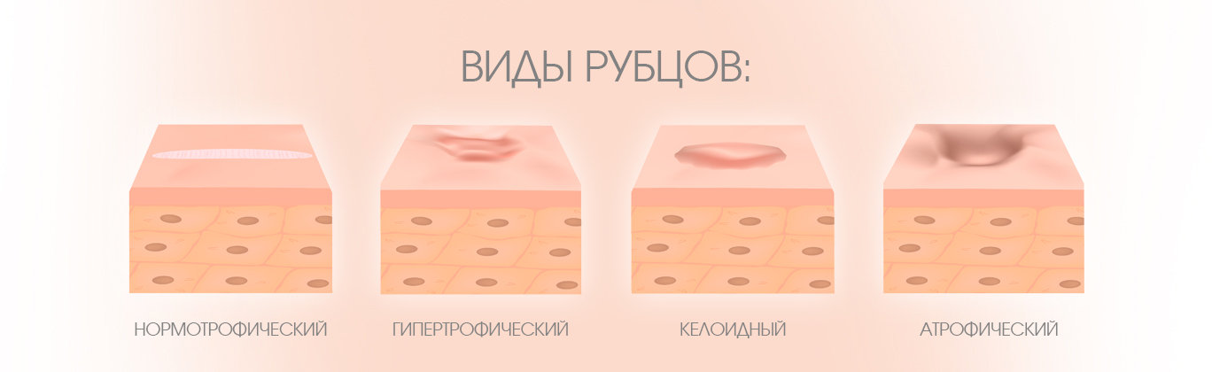 Виды послеоперационных рубцов