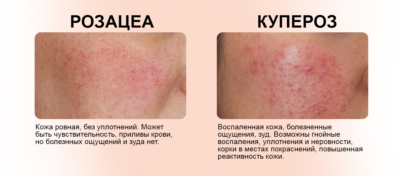 Розацеа-купероз