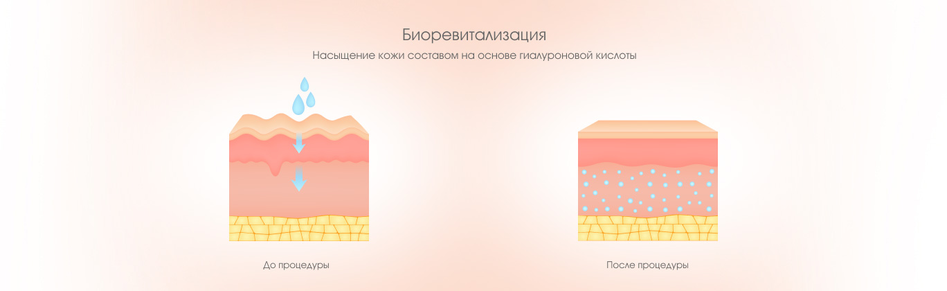 Биоревитализация
