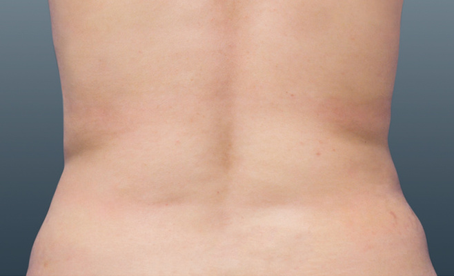 CoolSculpting-тело после процедуры