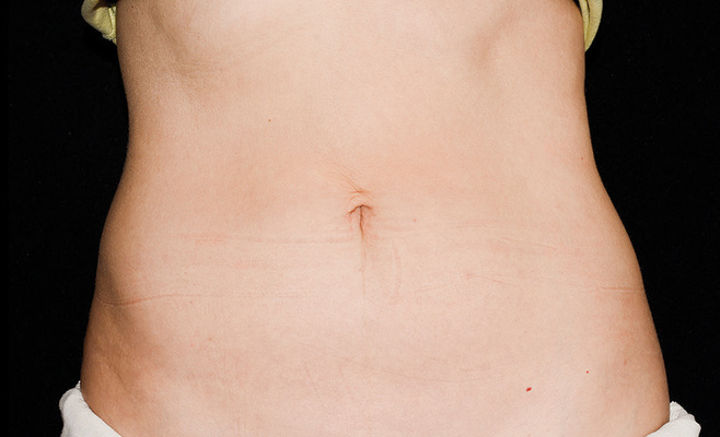 CoolSculpting-живот после процедуры