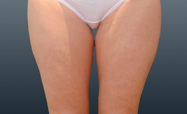 CoolSculpting-ноги до процедуры