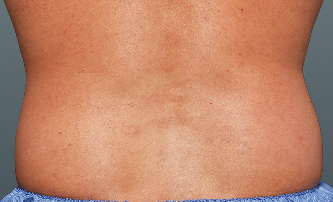 CoolSculpting-скульптор фигуры до процедуры