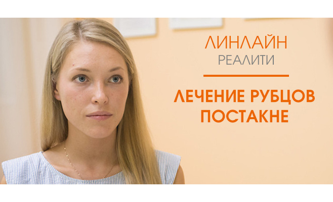 Лазерное лечение рубцов постакне. Проект ЛИНЛАЙН-реалити